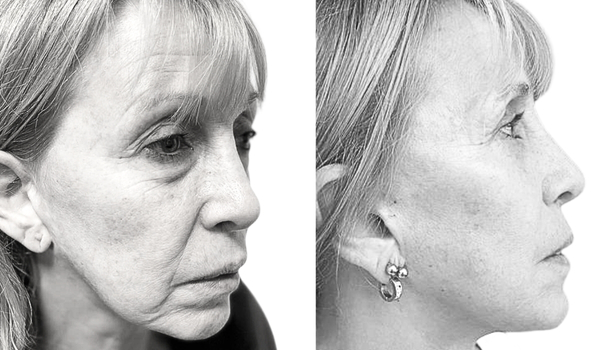 Casos Cirugía Plástica Olivos