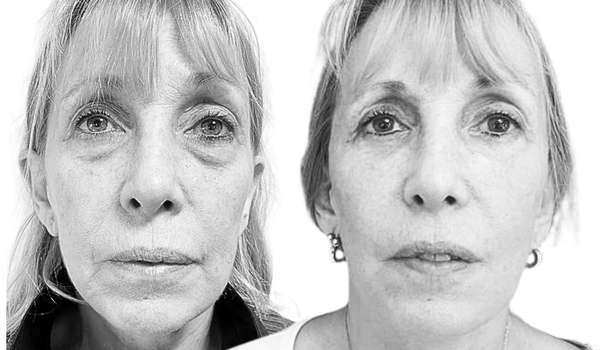 Casos Cirugía Plástica Olivos