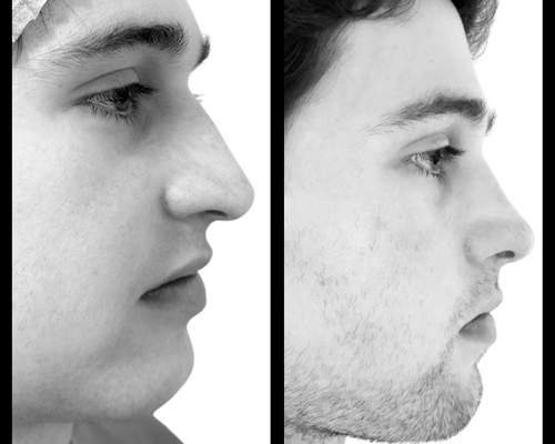 caso real Cirugía Plástica Olivos