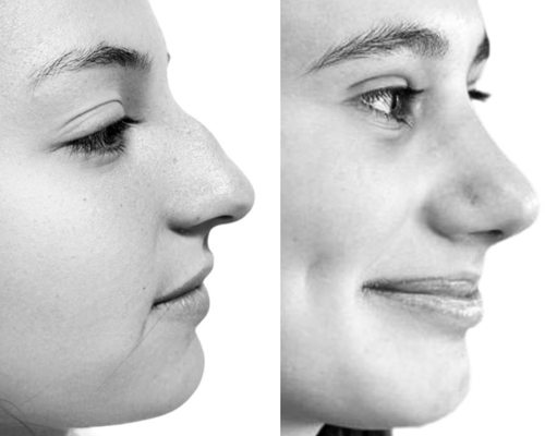 caso real Cirugía Plástica Olivos